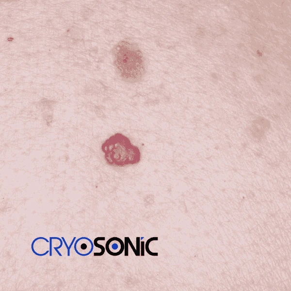 Looking for pain free cherry angioma removal treatment Bury? Call our team today! Bury