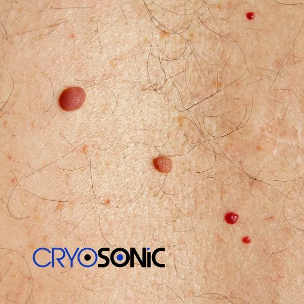 get cherry angioma removal treatment today! Bury