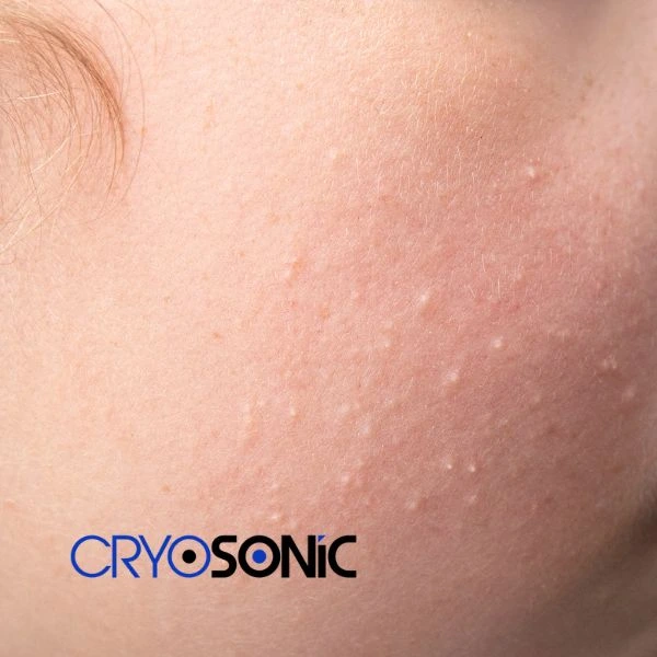 Are you looking for milia removal treatment? Contact our team today Bury
