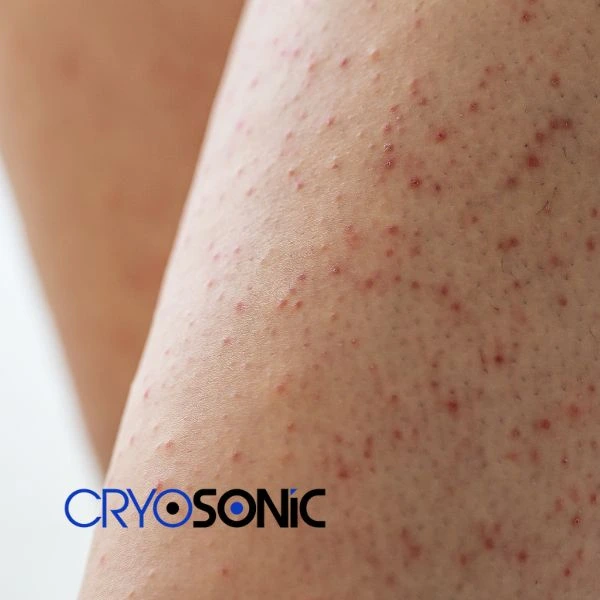 Looking for Seborrhoeic Keratosis removal Bury treatment? Call our consultants today in Bury