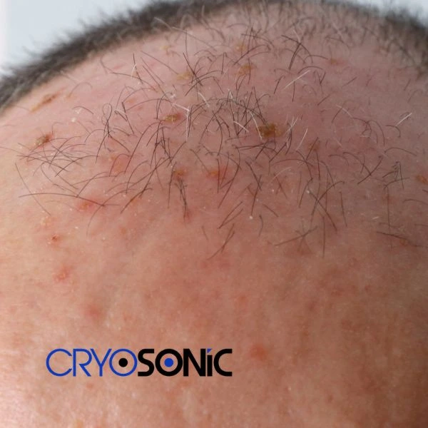 Access Seborrhoeic Keratosis removal from the comfort of your own home! Call us today in Bury