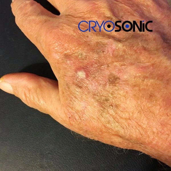 Understand more about actinic keratosis treatment today Bury