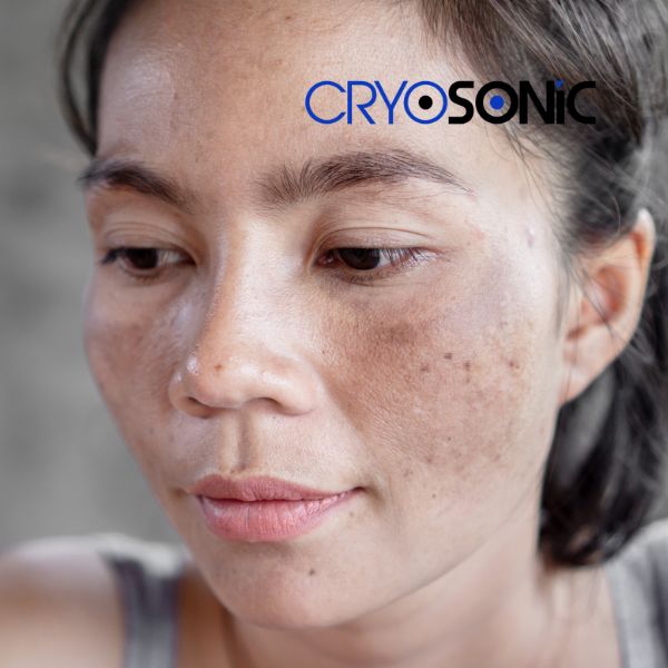 Ready to start age spots removal? Contact our team today in Bury