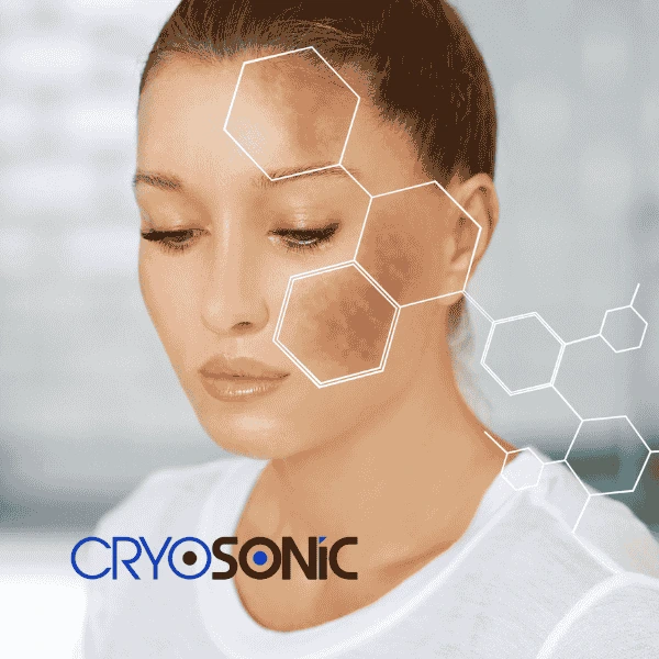 Are you looking for age spot removal treatment? Contact Cryosonic today in Bury
