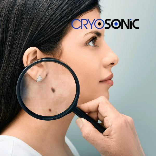 Do you want to learn more about benign moles removal treatment? Call our team today Bury