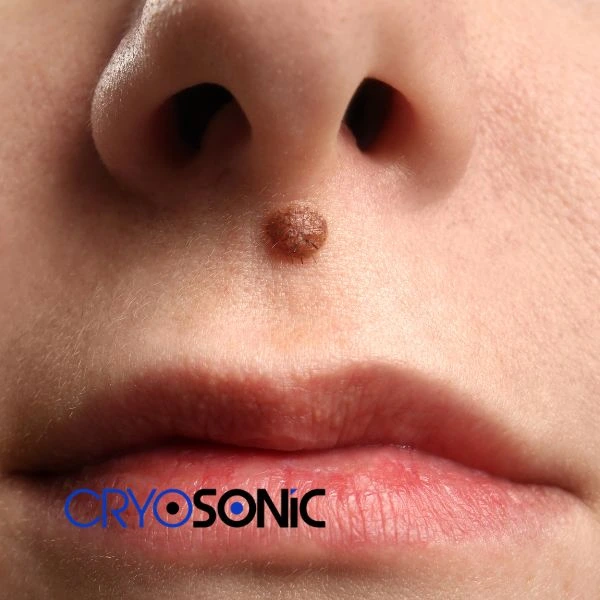 Start your benign moles removal treatment today Bury
