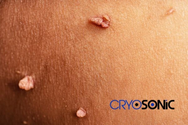 What Can You Expect During and After Your Cryosonic Treatment Bury