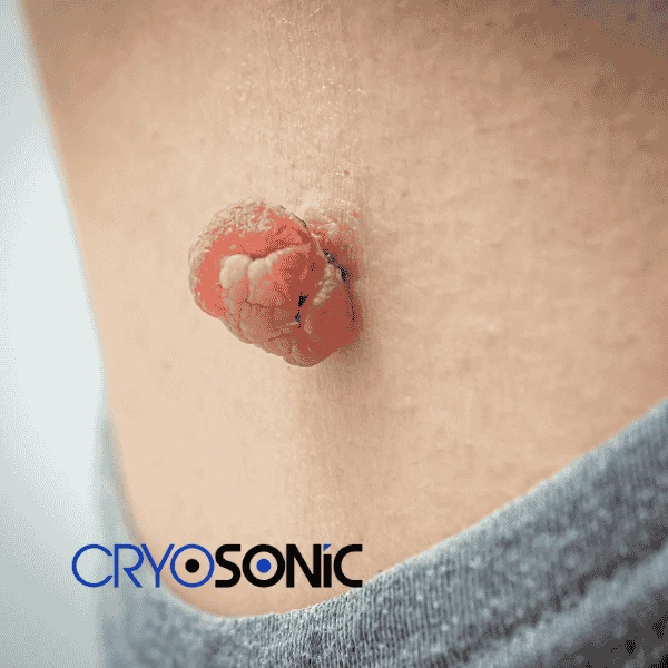 Book your skin tags removal Bury from comfort of your own home! Bury