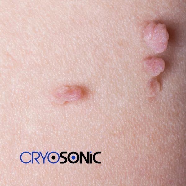 Are you looking for fast effect skin tag removal Bury? Book in NOW! Bury